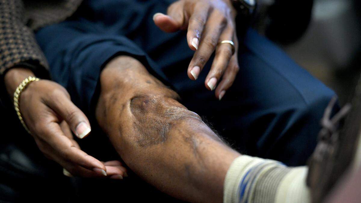 Derrick Randall, U.S. Army veteran and CEO and director of the United Community Center’s 13th Av Dream Center and the Rubonia Community Program, shows the wound he suffered from an IED in Iraq.