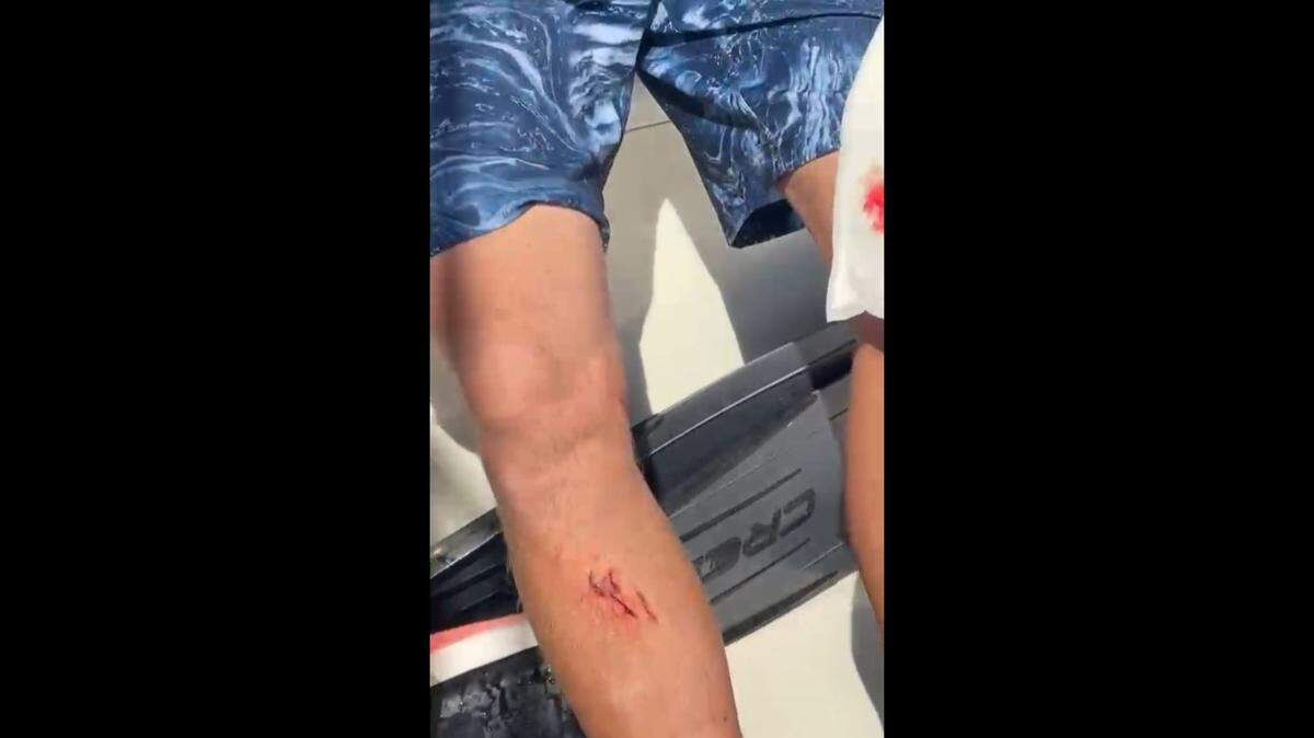 Local spearfisherman Mike Stowe suffered cuts on his lower legs after a bull shark attacked him while diving near Anna Maria Island.