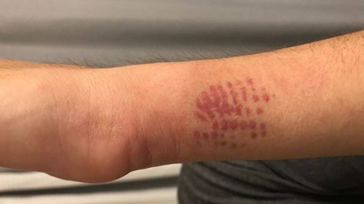 What started as a rash on a 15-year-old Florida boy's wrist spread to his chest. The marks left on Logan Pergola's arm show where he came into contact with the venomous caterpillar.
