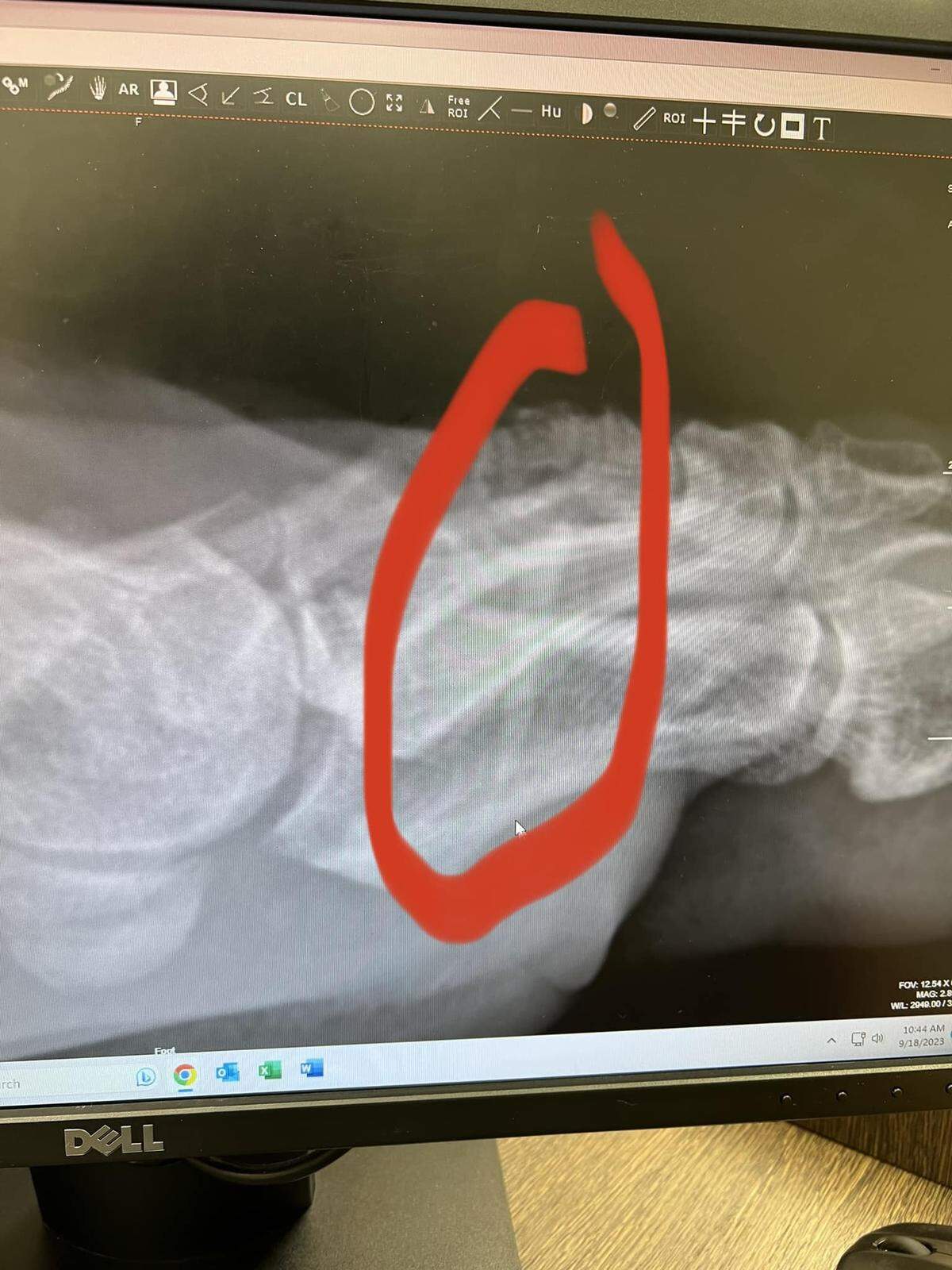 While fishing with his 7-year-old son, Palmetto fisherman Carl Gretenhardt had an extremely painful accident with a catfish that required surgery to remove a barb that became stuck in his foot.