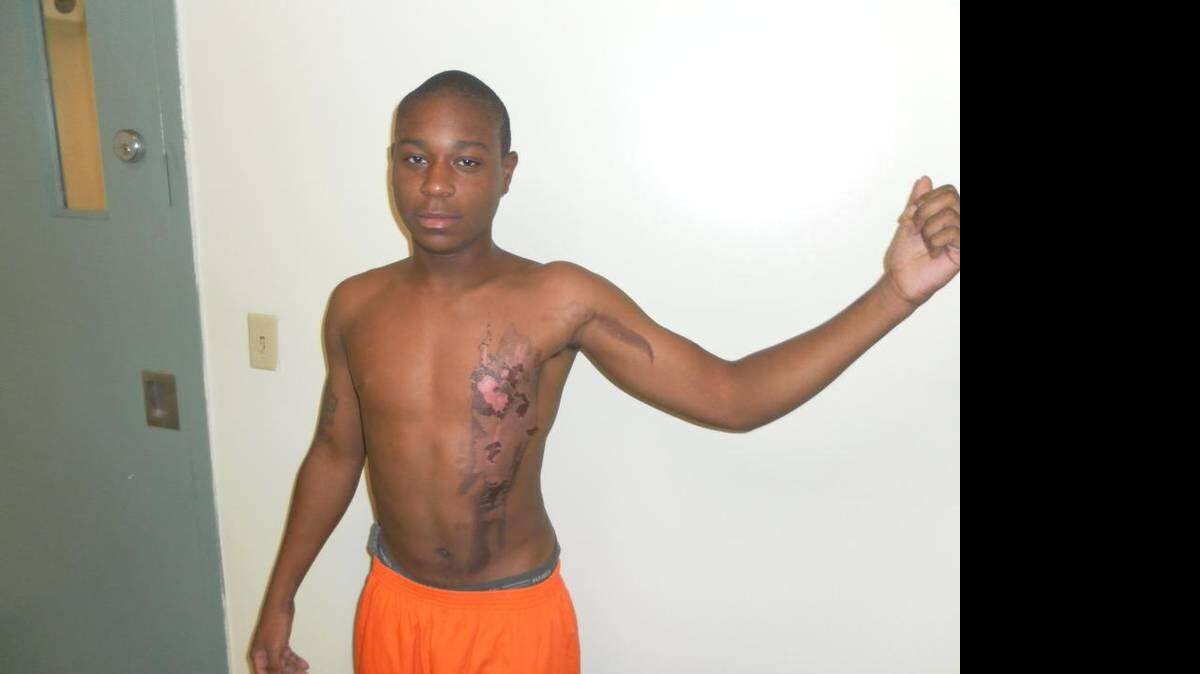Former Miami-Dade jail inmate Joshua Wiggins shows second-degree burns he suffered after a corrections officer doused him with scalding water in August 2012. Miami-Dade State Attorney’s Office
