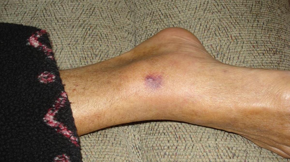 This photo provided by Patty Konietzky shows her husband's foot of what they thought was a bug bite on Sept. 22, 2013, in Ormond Beach, Fla. Patty and her husband, Henry "Butch" Konietzky, went crabbing in the Halifax River near Ormond Beach that month. Butch developed a sore which was later confirmed to be vibrio vulnificus. The bacteria spread quickly in his body and he died 60 hours later.