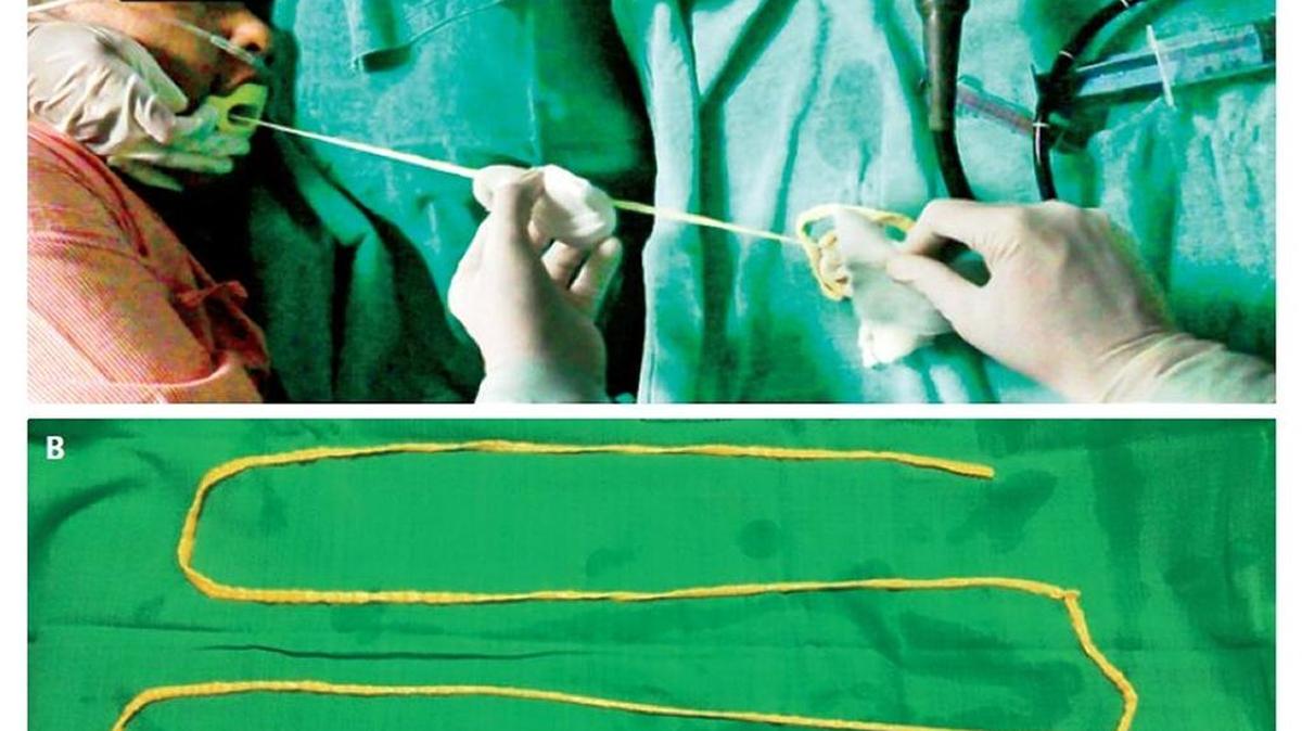 A 6-foot tapeworm was removed through a man’s mouth in India.