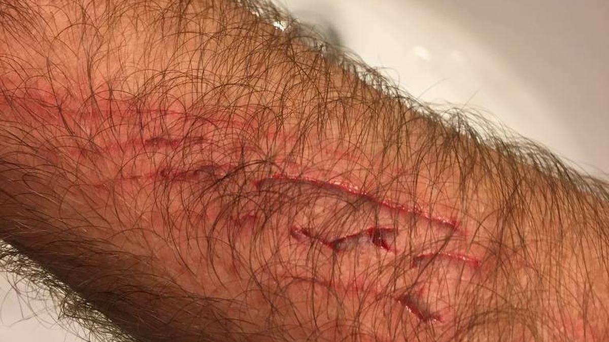 The series of forearm cuts caused by a kingfish are visible after being cleaned. Jon Chapman sustained the injury while landing a kingfish while fishing approximately 17 miles offshore this past week.